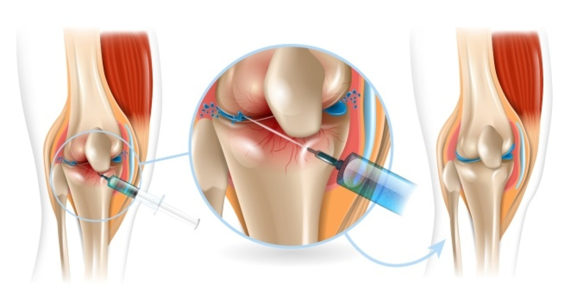 The Cost of Joint Injections: A Complete Guide