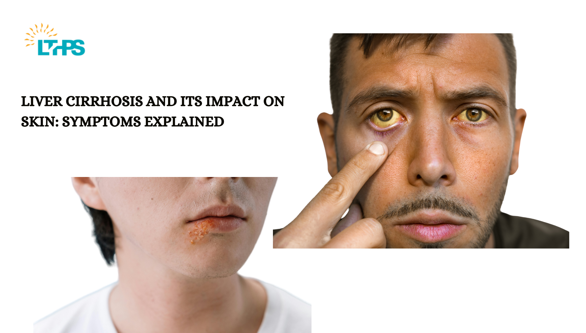 Liver Cirrhosis Skin Symptoms & Effects